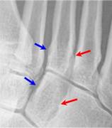 Lisfranc with arrows-3